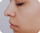 تزریق فیلر بینی جهت اصلاح فرم - قبل از درمان